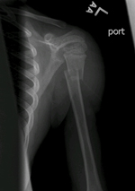 Broken Arm